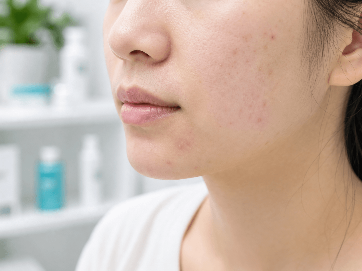 Generated clinical photo showing mild acne on the cheek and jaw