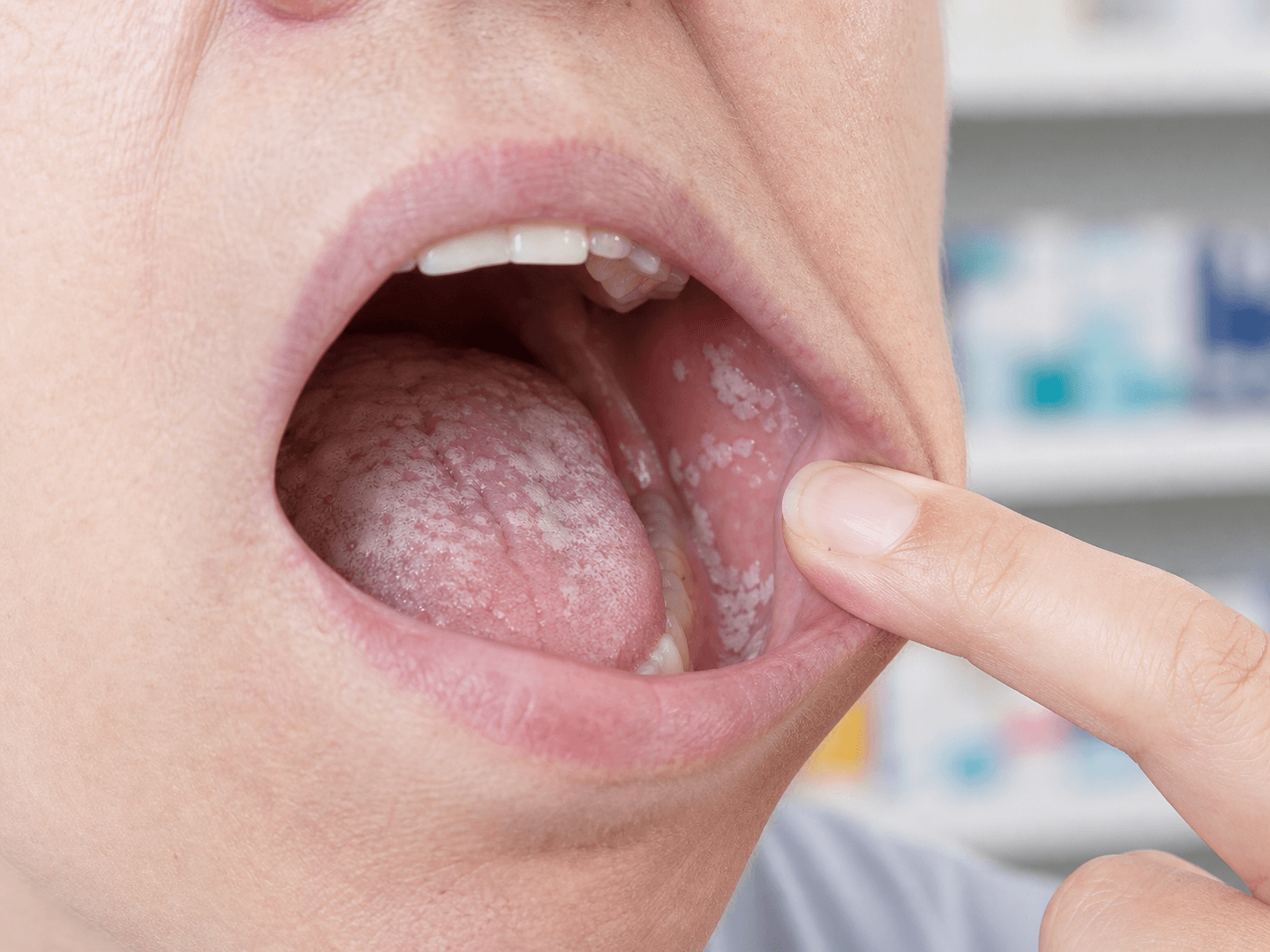 Generated clinical photo showing oral thrush plaques on the tongue