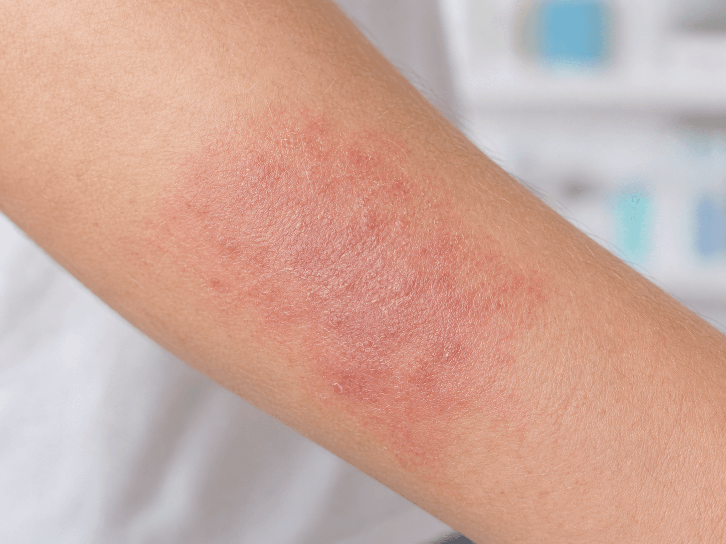 Generated clinical photo showing eczema-like dermatitis on the forearm