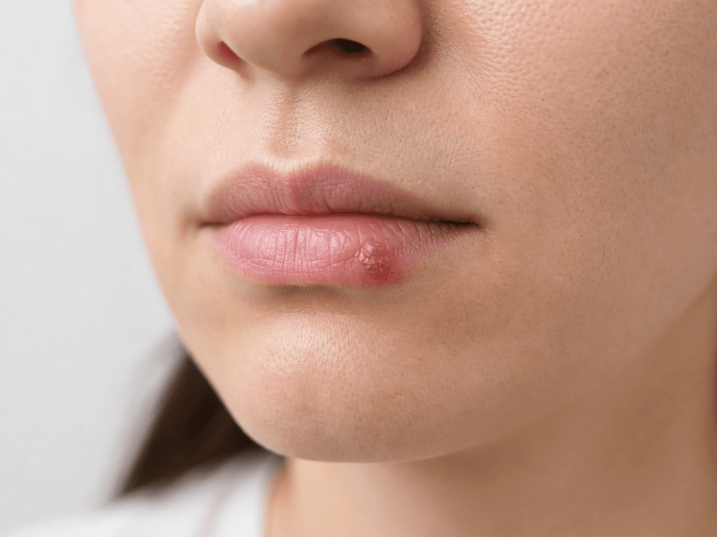 Generated clinical photo showing a cold sore on the edge of the lip
