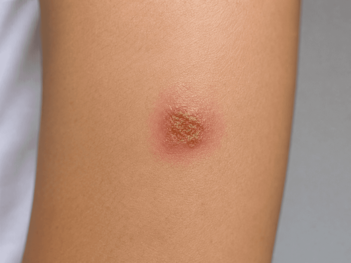 Generated clinical photo showing localized impetigo with honey-colored crust on skin