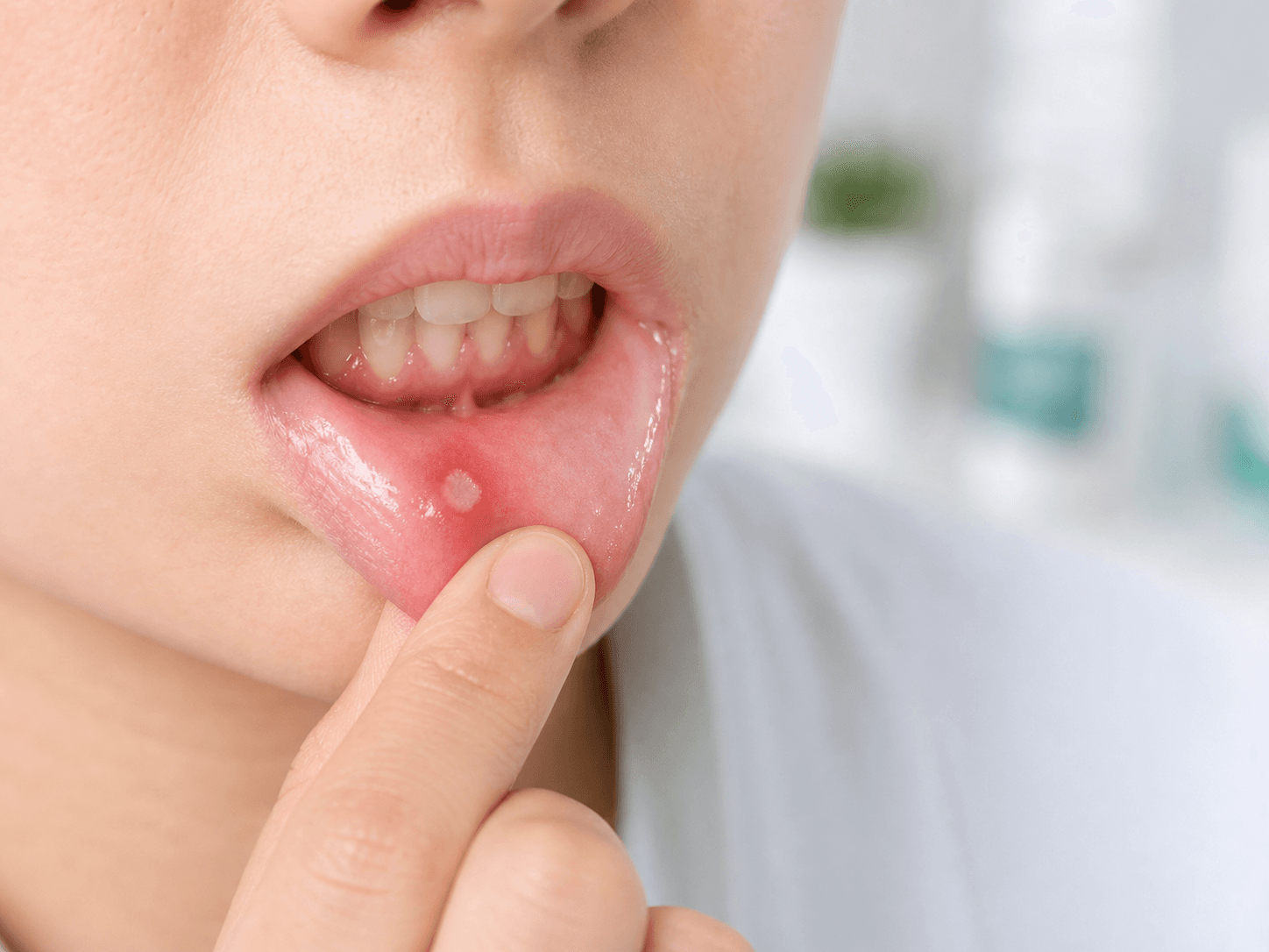 Generated clinical photo showing a small aphthous ulcer inside the lower lip