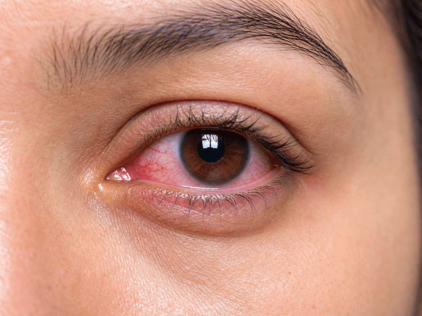 Generated clinical photo showing conjunctivitis with a red irritated eye
