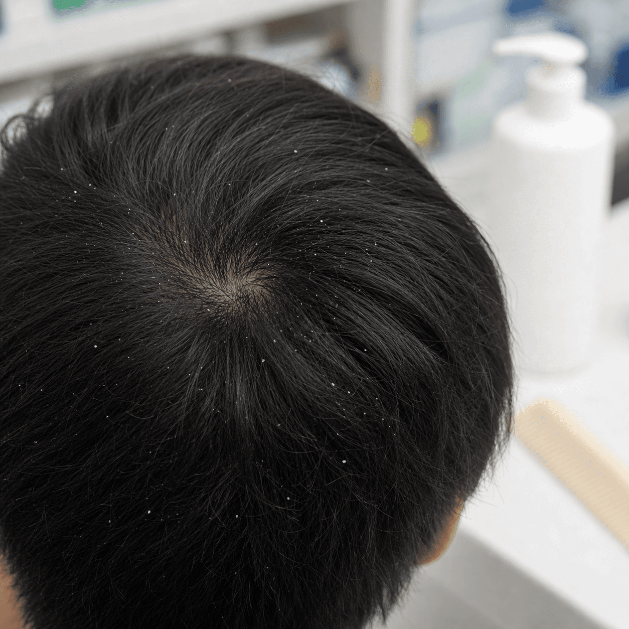 Generated clinical photo showing dandruff flakes on dark hair during a discreet scalp consultation