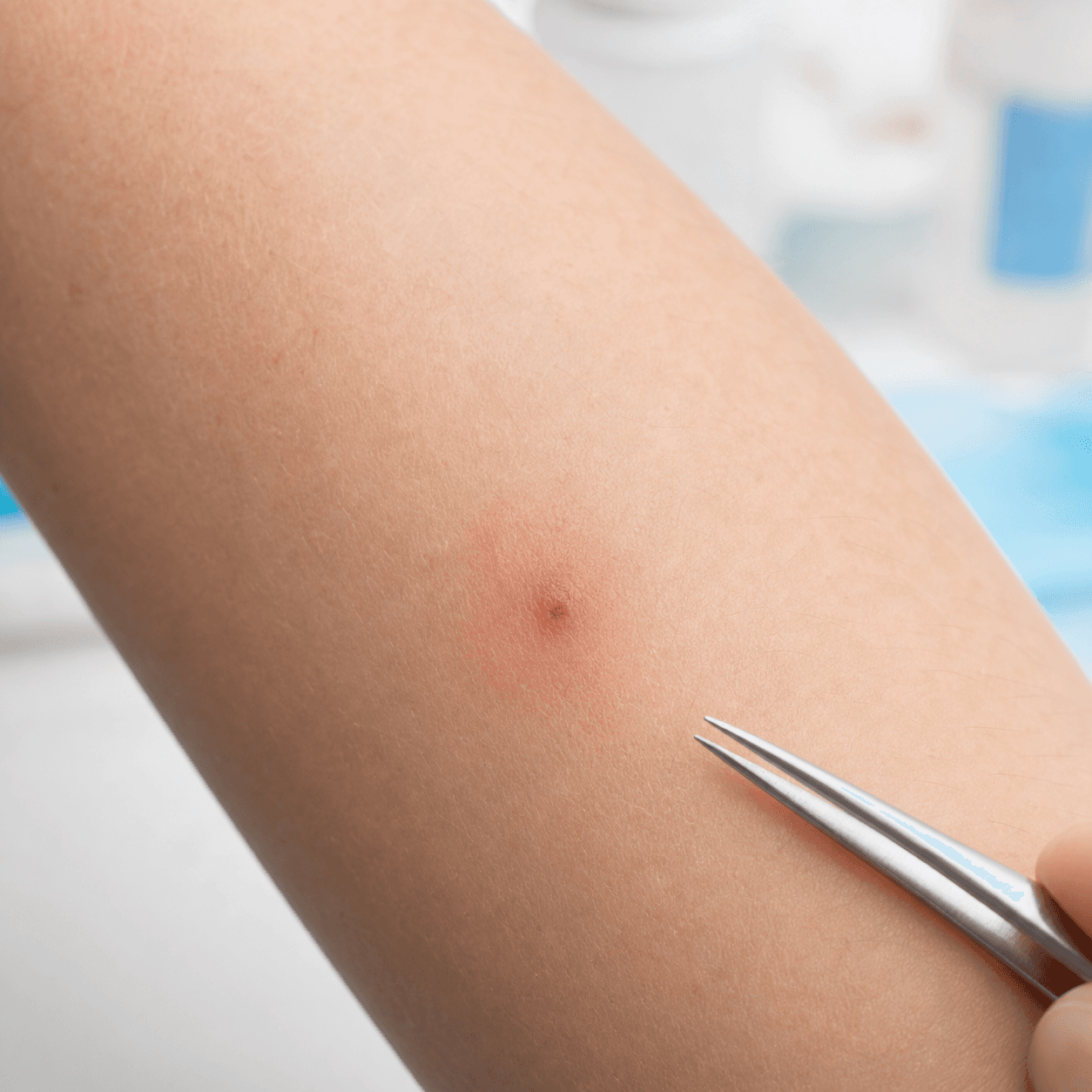 Generated clinical photo showing a tick bite being examined on skin with tweezers nearby